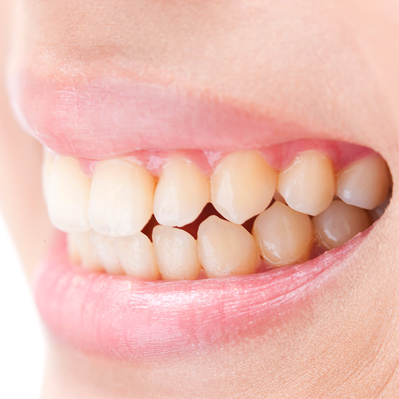 歯ぎしり・食いしばり